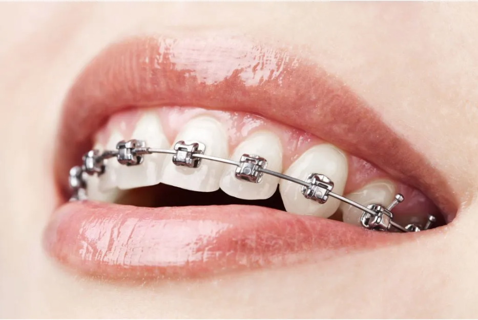 Mini Brackets (แบรกเก็ตขนาดเล็ก)