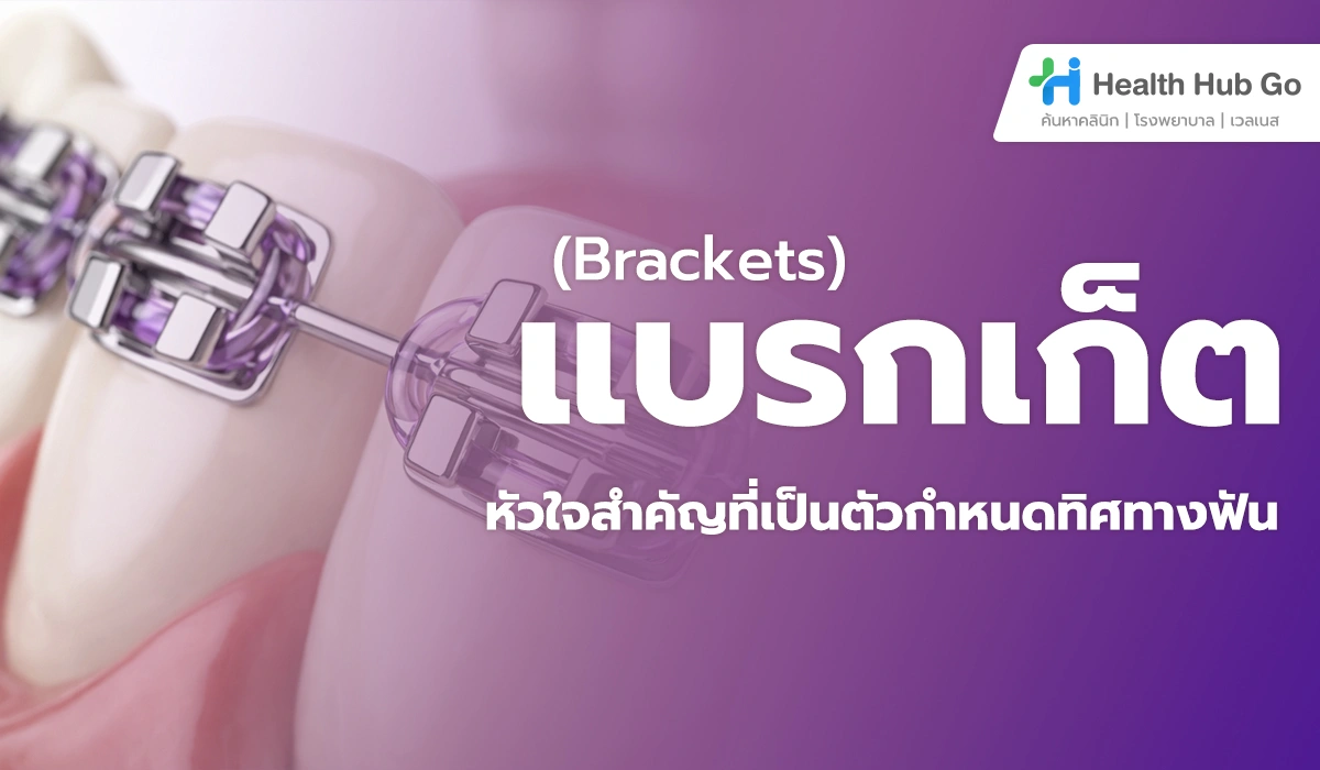 Brackets (แบรกเก็ต) คืออะไร : หัวใจสำคัญของการจัดฟันที่หลายคนมองข้าม