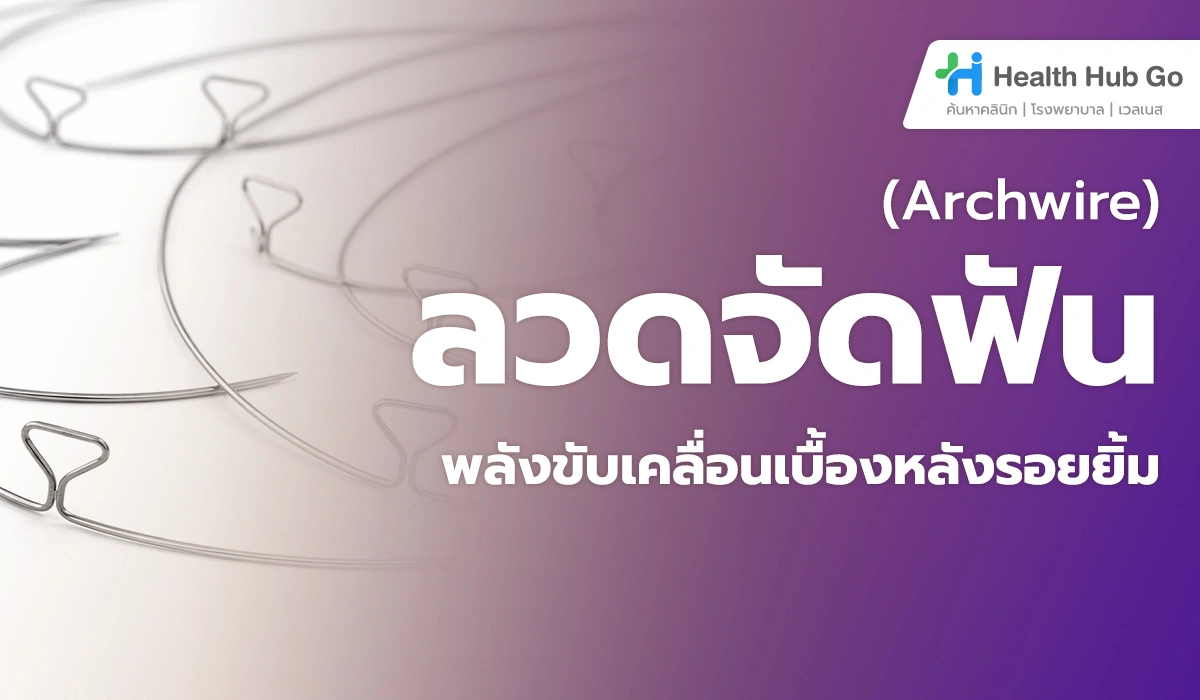 Archwire (ลวดจัดฟัน) คืออะไร : ตัวขับเคลื่อนหลักที่ทำให้ฟันเคลื่อน