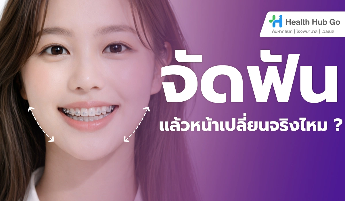 จัดฟันแล้วหน้าเปลี่ยนจริงไหม : ความจริงที่ควรรู้ก่อนตัดสินใจจัดฟัน