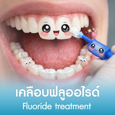 เคลือบฟลูออไรด์